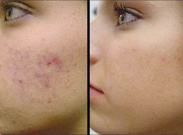 Radiofrequence Cicatrice Acne