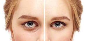 les rides avant et après