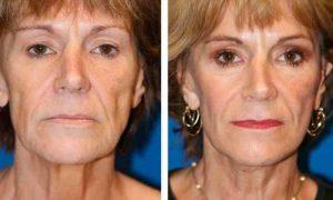 radiofréquence sans rides