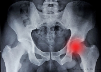 Radiofréquence pour l'atrose de la hanche